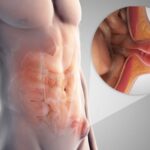 Θυρεοειδής: Αφαίρεση με μικρή τομή Newsroom