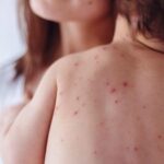 Οι χορτοφάγοι έχουν σημαντικά μικρότερο κίνδυνο για 5 μορφές καρκίνου Αναστασία Σταματιάδου